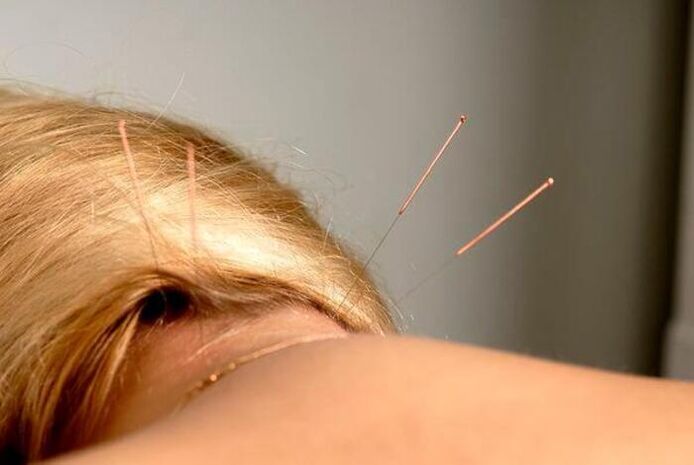 Acupuncture pour l'ostéochondrose