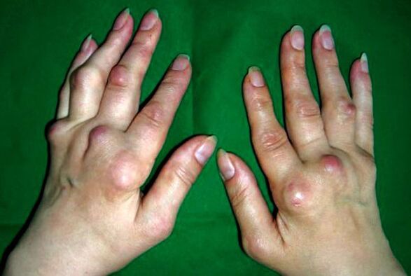 Mains atteintes de polyarthrose déformante