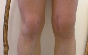 Stades de développement de l'arthrose du genou