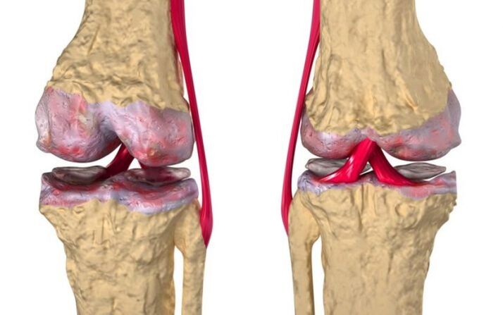 Arthrose de l'articulation du genou