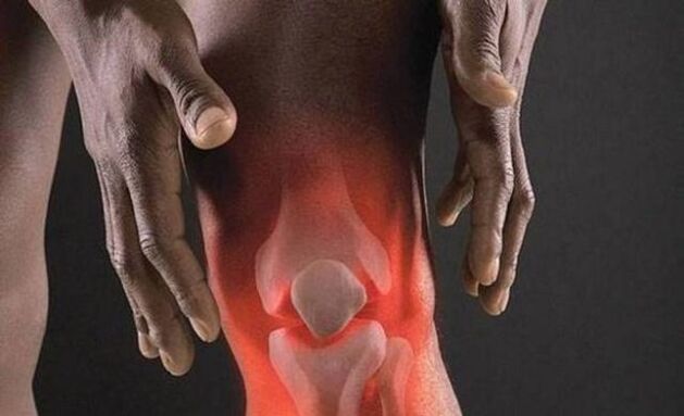 L'arthrose s'accompagne d'un processus inflammatoire dans l'articulation du genou
